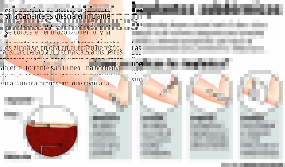 Implante subdermal